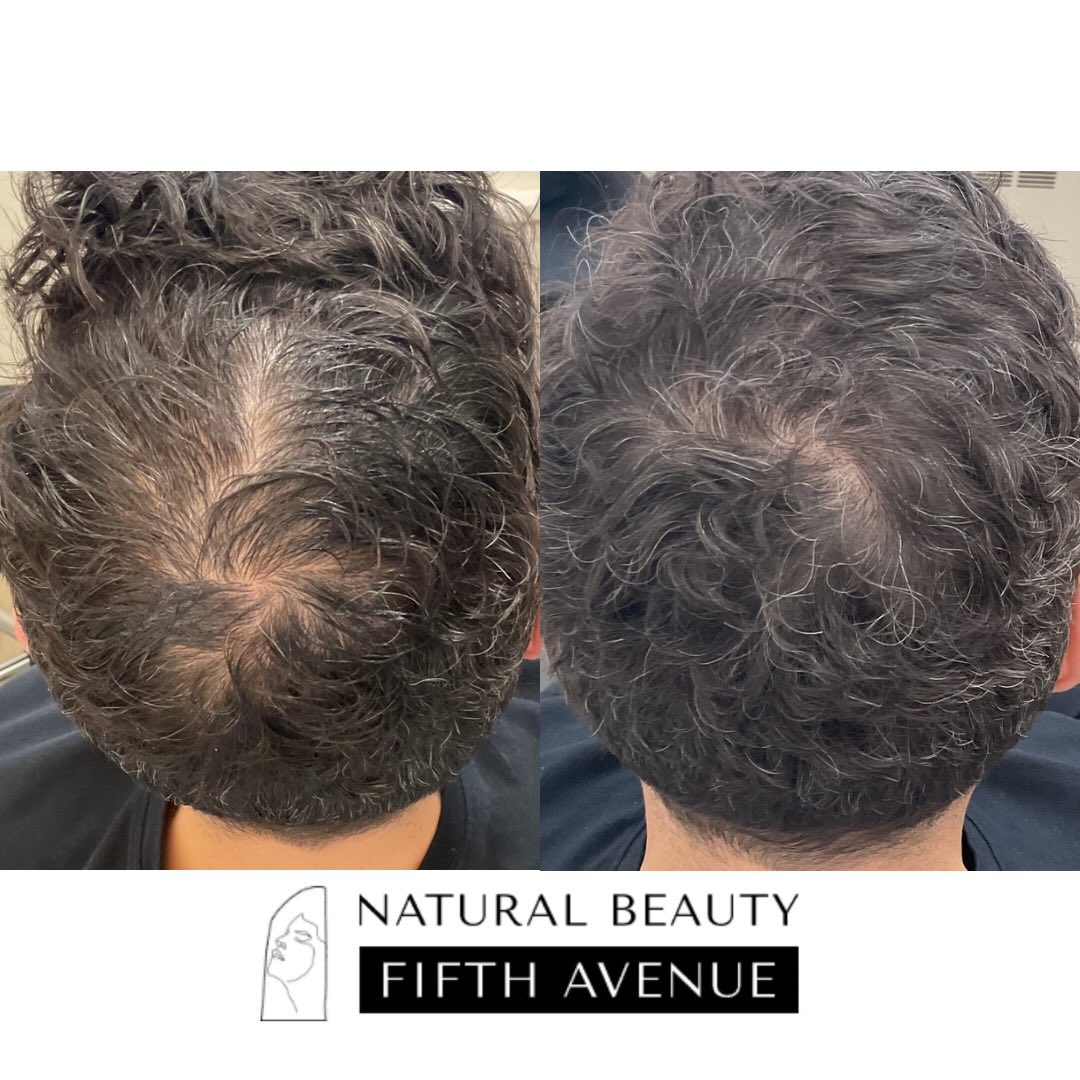Before and after hair restoration results showing increased hair density on the crown and back of head